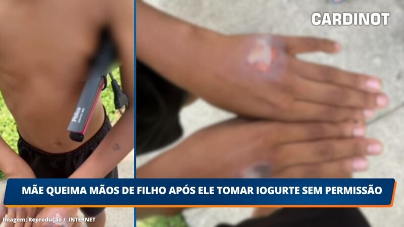 Mãe queima mãos de filho após ele tomar iogurte sem permissão