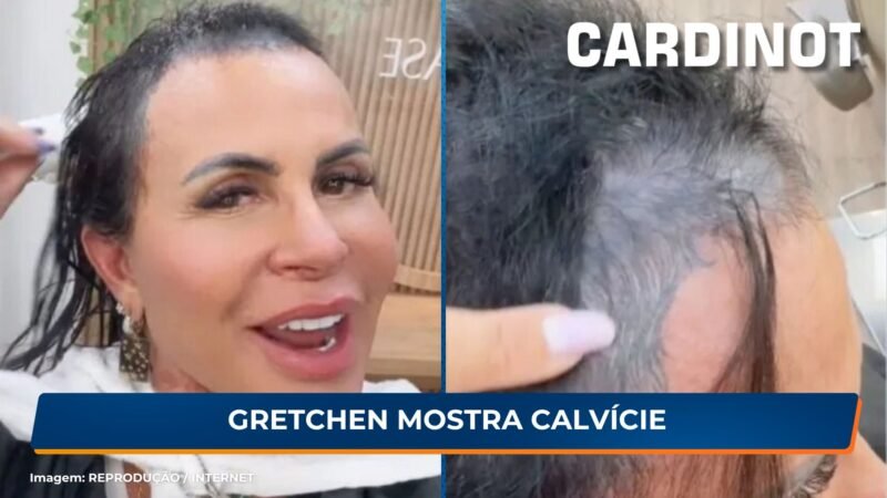 Gretchen mostra calvície