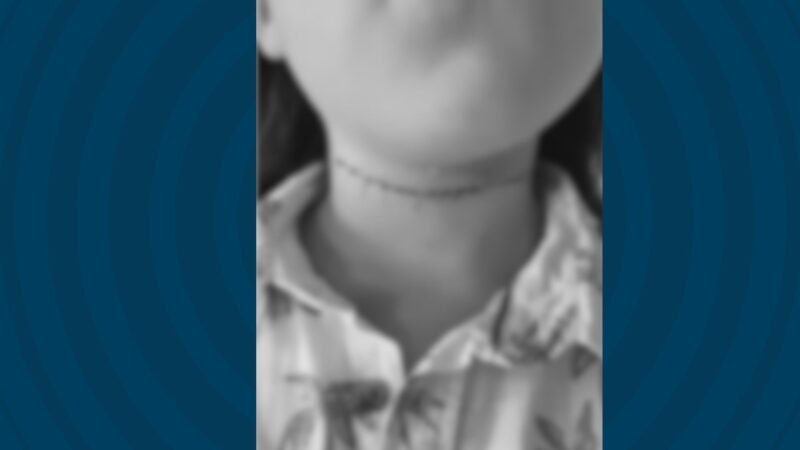 🚲⚠️ Menino de 10 anos é ferido por linha com cerol em condomínio de Camaragibe