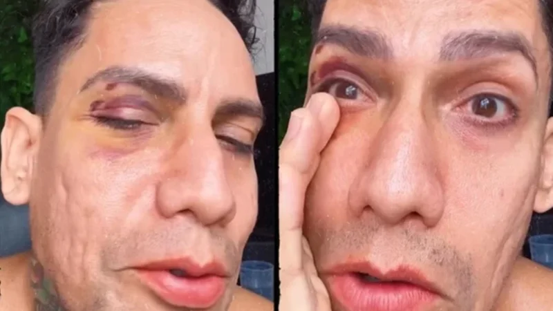 🔴 ARQUITETO É AGREDIDO COM SOCO NO CARNAVAL DE OLINDA E DENUNCIA ATAQUE HOMOFÓBICO